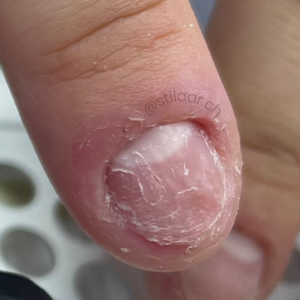 Onychophagie, Nägelkauen professionell behandeln, als Nageldesignerin in der Schweiz