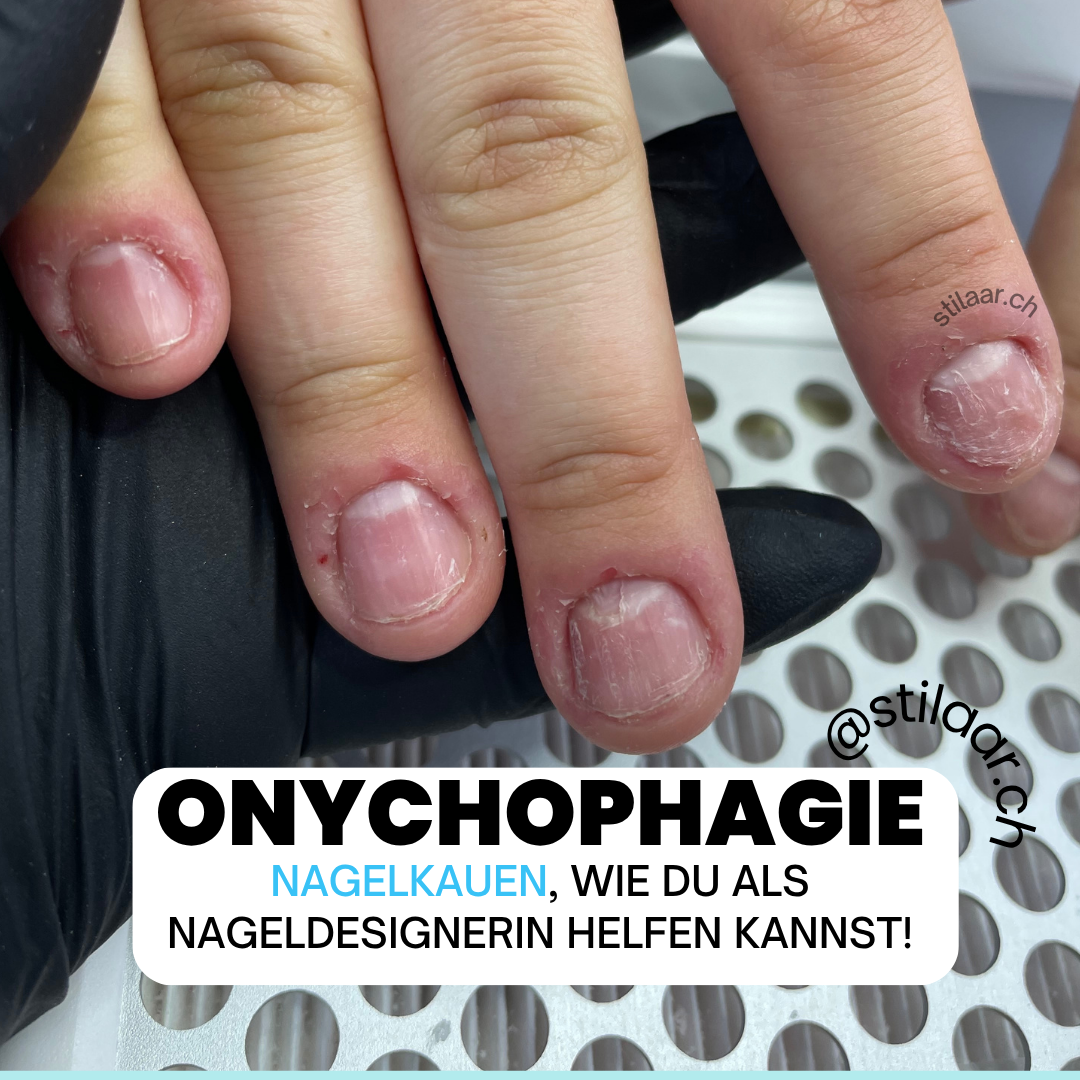 Onychophagie, Nägelkauen professionell behandeln, als Nageldesignerin in der Schweiz